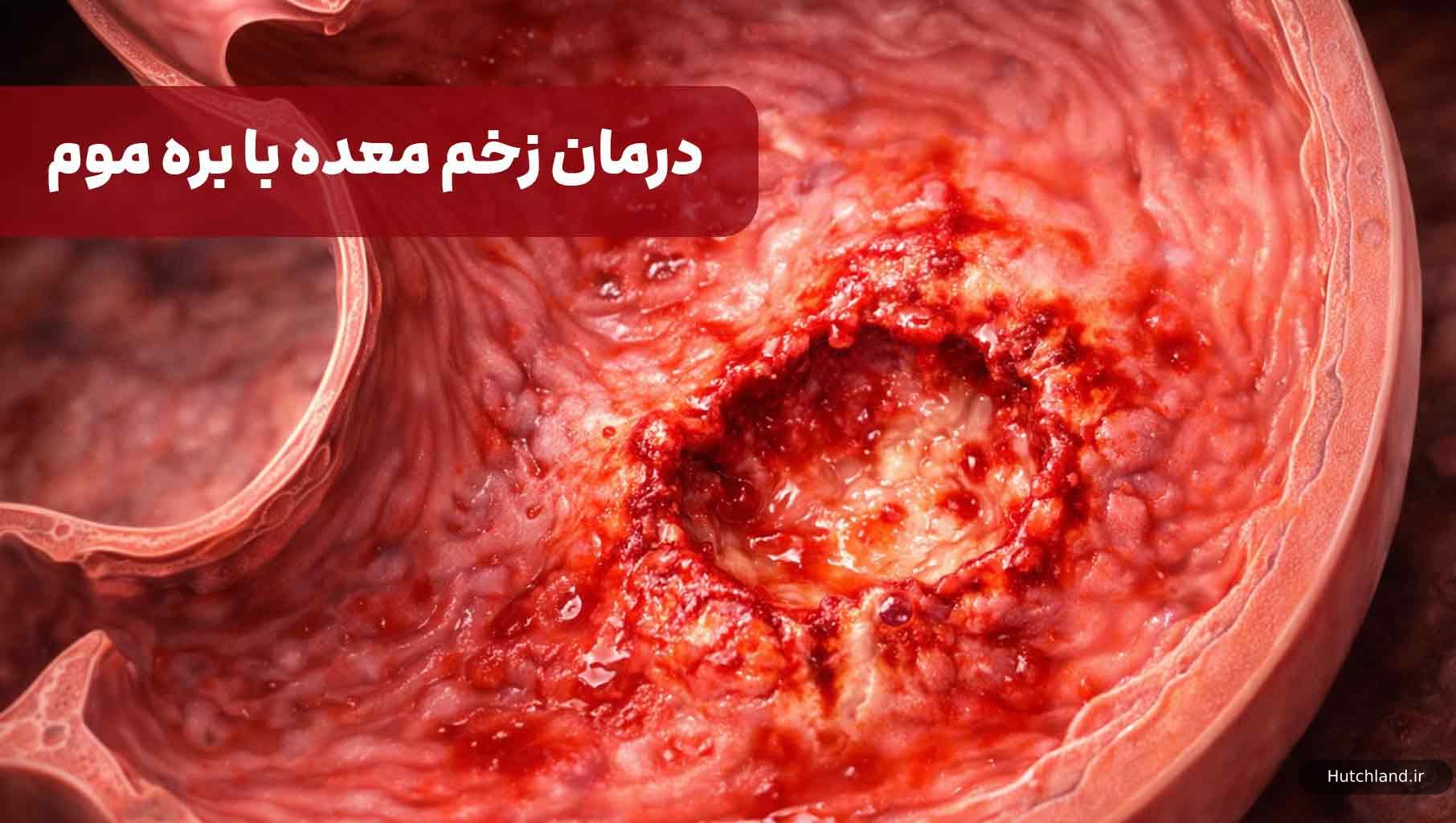 درمان زخم معده