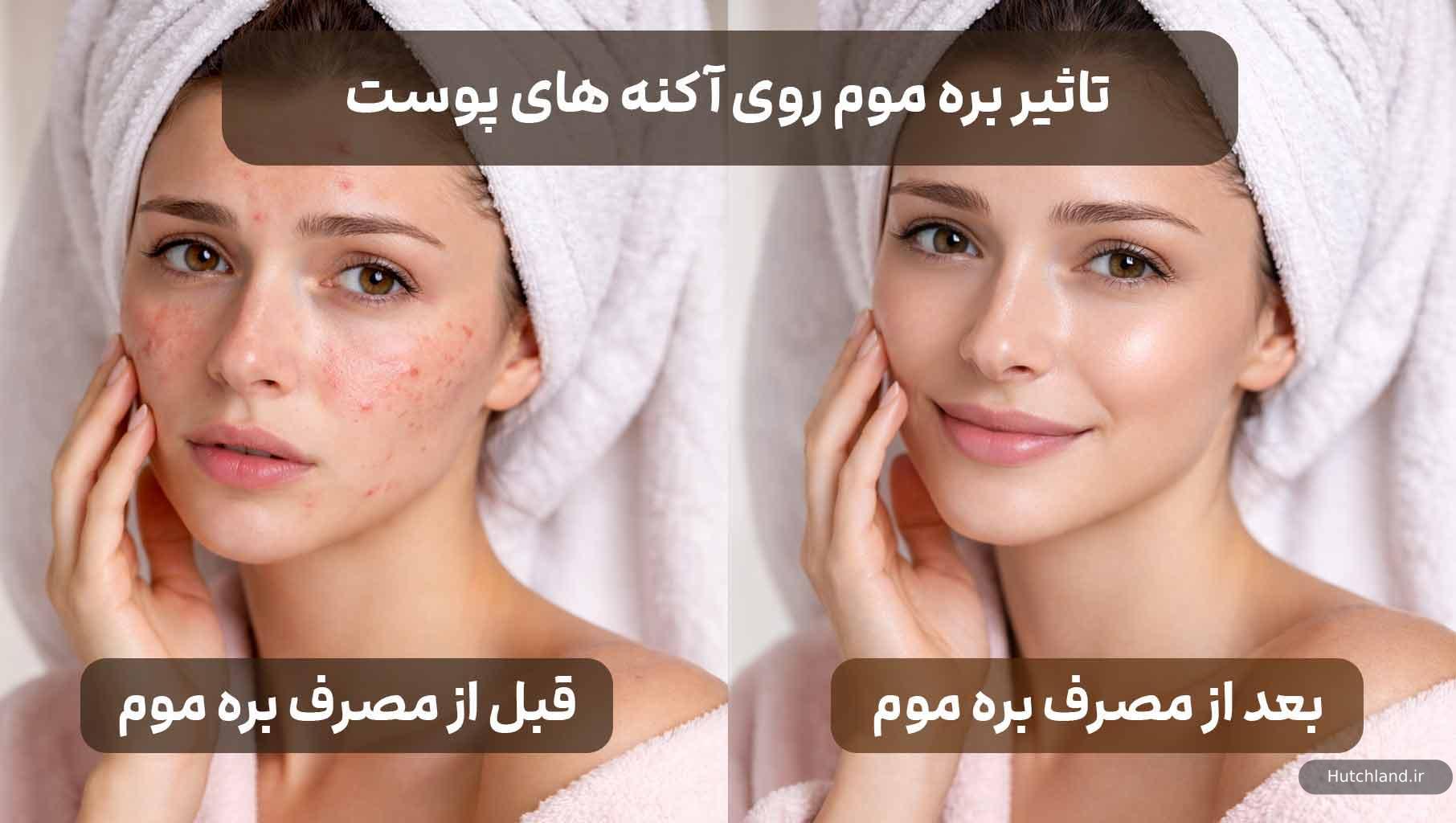 تاثیر بره موم روی آکنه های پوست 