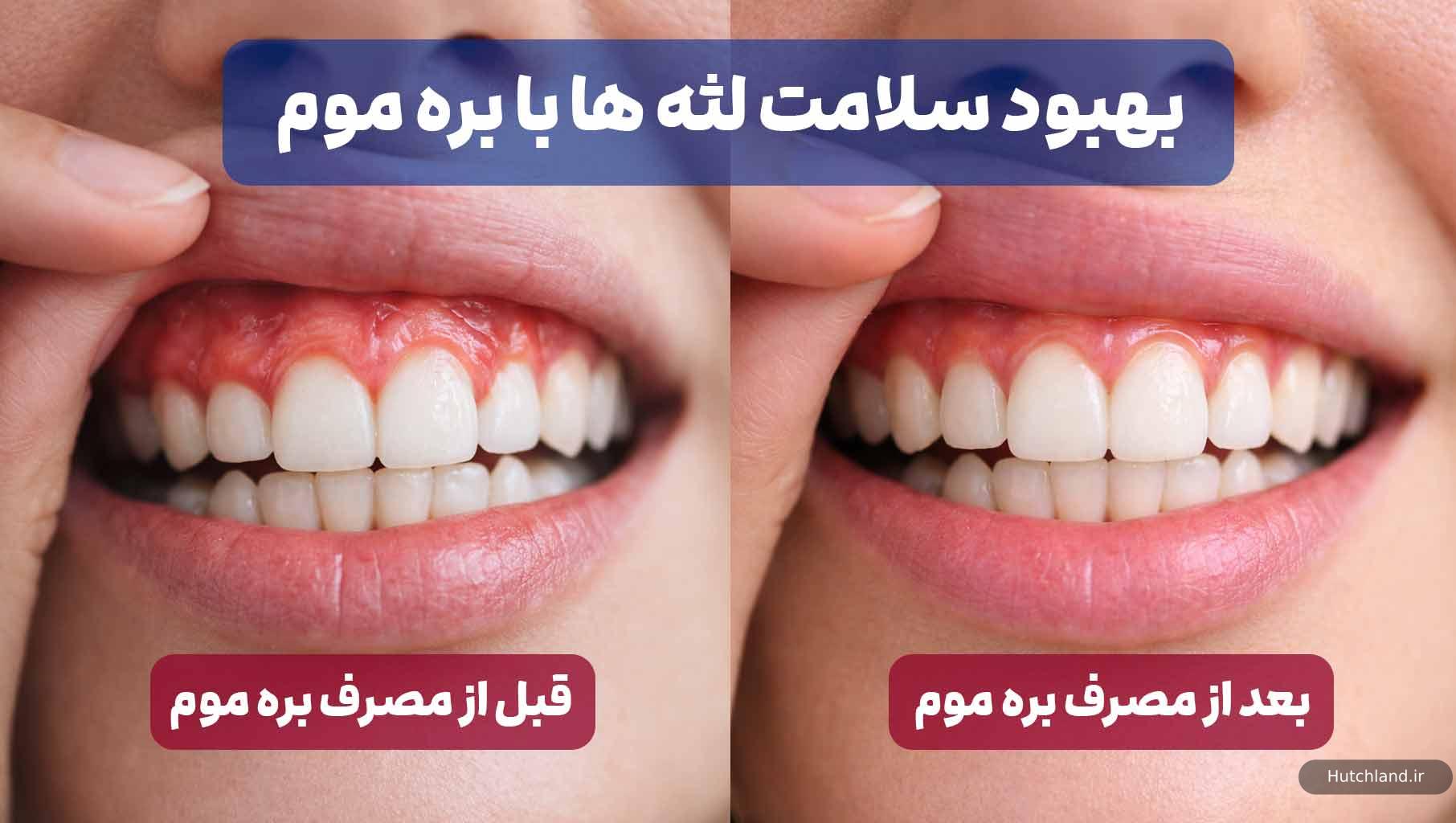 سلامت لثه ها با بره موم 