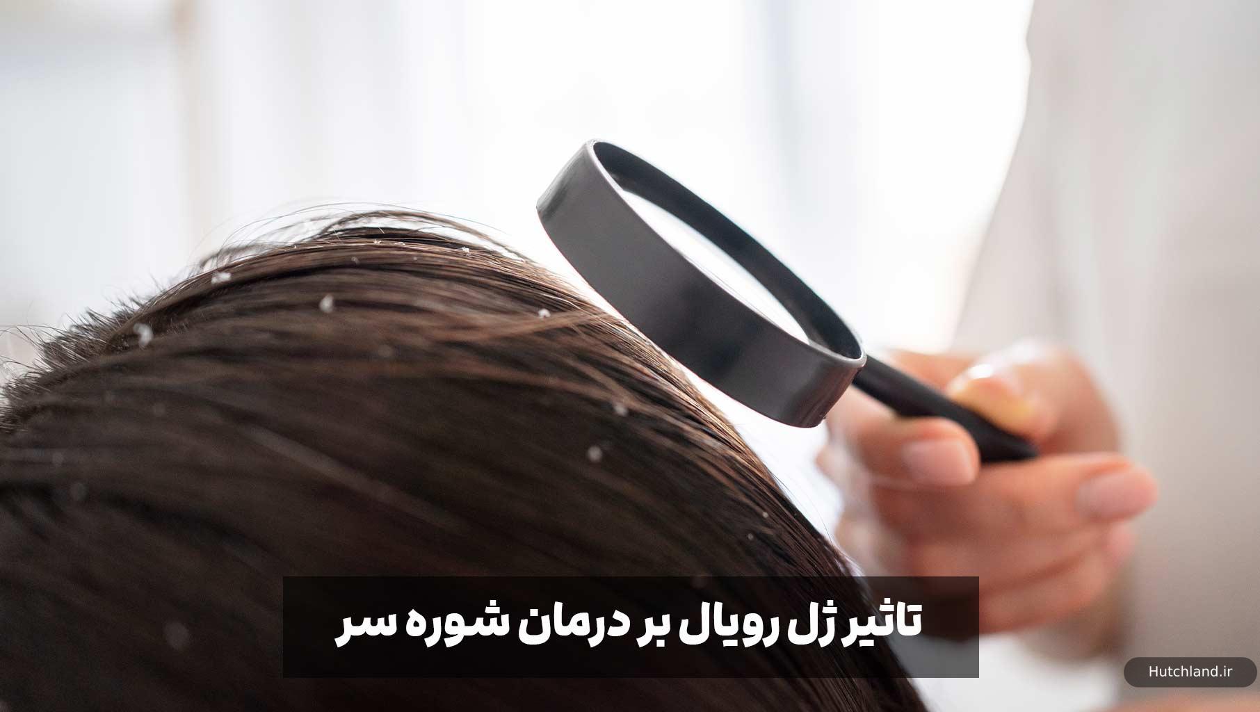 تاثیر ژل رویال بر درمان شوره سر